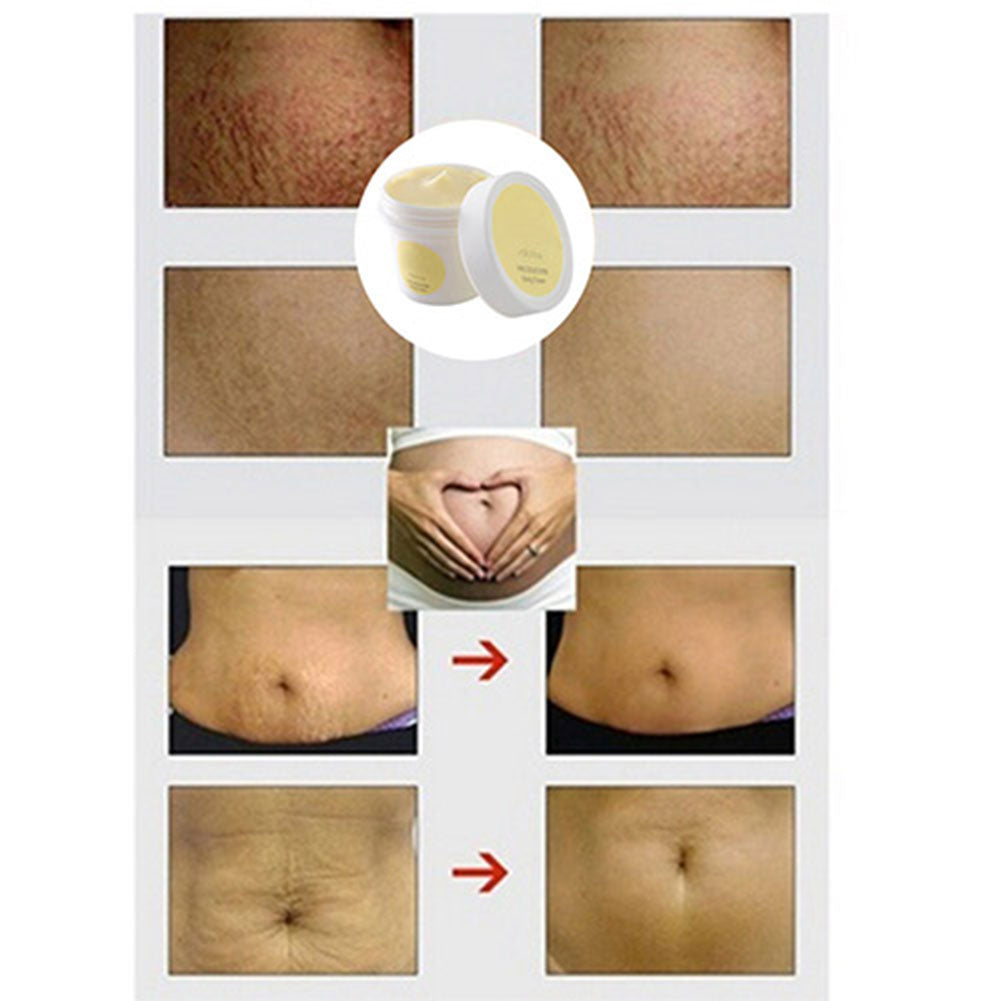 Cream Remove Scar Stretch Marks Care Postpartum Maternity Skin Body Repair Care