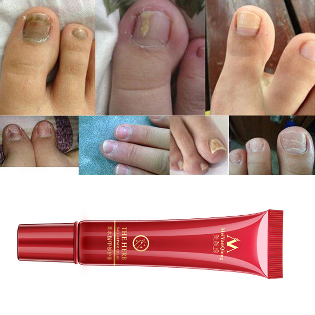 Onychomycosis Paronychia Anti Infection Chinese Herbal Toe Nail Fungus Treatment