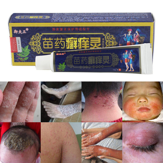 Herbal Bacteriostasis Tinea Ointment Antipruritic Dermatitis Eczema Treatment