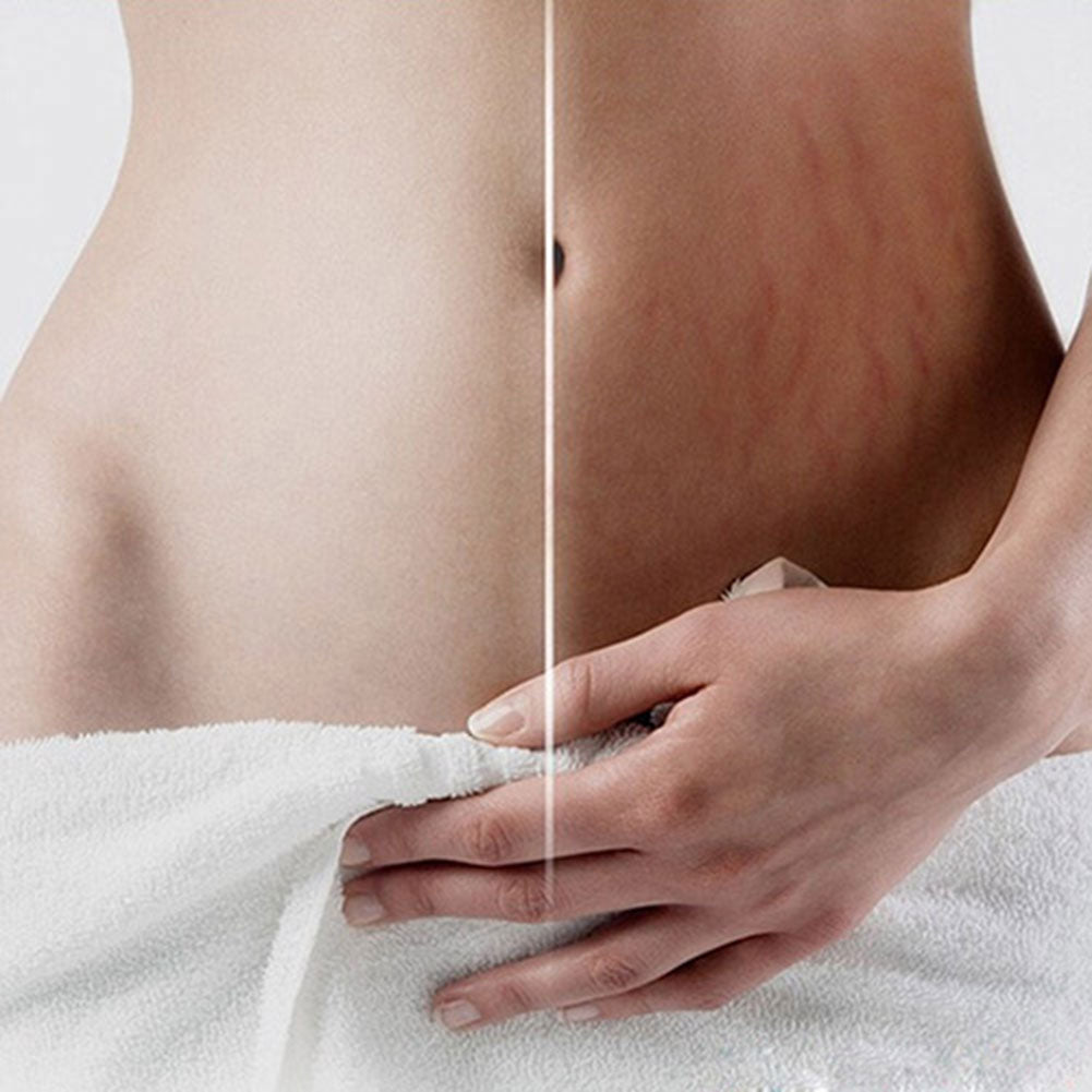Cream Remove Scar Stretch Marks Care Postpartum Maternity Skin Body Repair Care